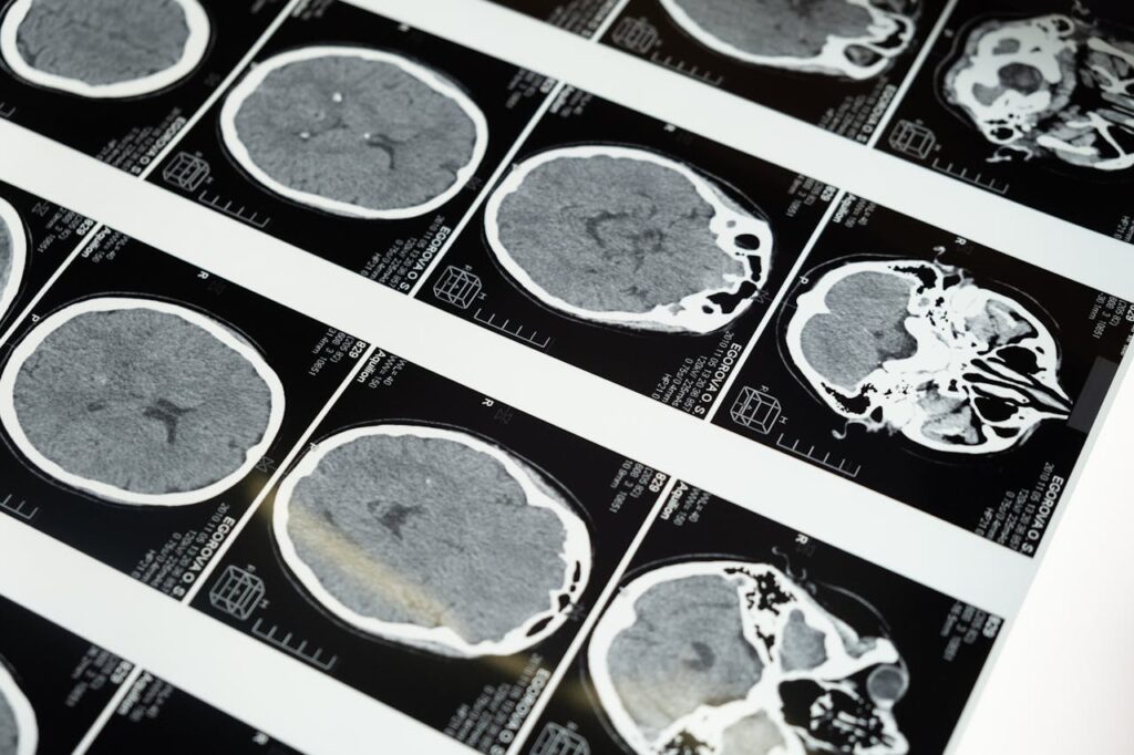 Crafting Captivating Headlines: Your awesome post title goes here Detailed brain MRI scans displayed on a lightbox, showcasing medical imaging techniques.